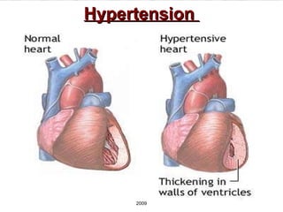 Hypertension   2009 