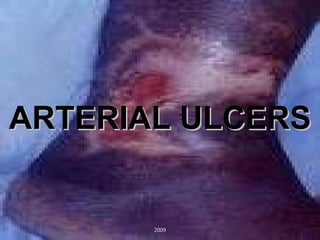 ARTERIAL ULCERS 2009 