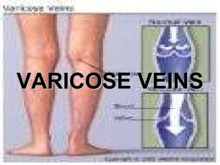 VARICOSE VEINS 2009 