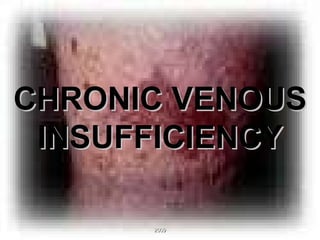 CHRONIC VENOUS INSUFFICIENCY 2009 