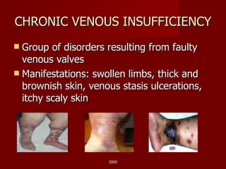 CHRONIC VENOUS INSUFFICIENCY Group of disorders resulting from faulty venous valves Manifestations: swollen limbs, thick and brownish skin, venous stasis ulcerations, itchy scaly skin 2009 
