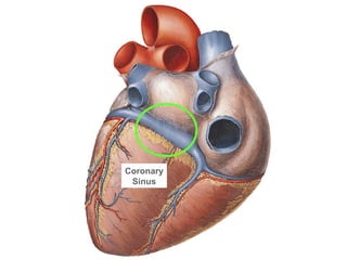 Coronary Sinus 