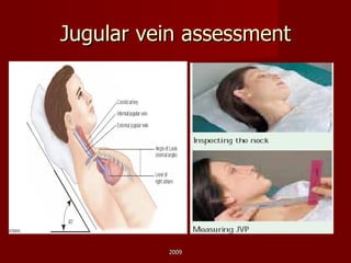 Jugular vein assessment 2009 