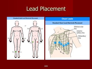 Lead Placement 2009 