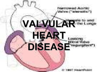 VALVULAR HEART DISEASE 2009 