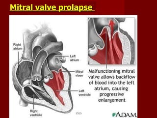 Mitral valve prolapse   2009 