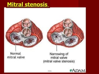 Mitral stenosis  2009 