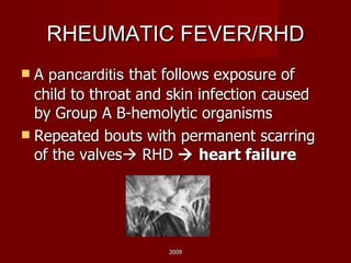 RHEUMATIC FEVER/RHD A  pancarditis  that follows exposure of child to throat and skin infection caused by Group A B-hemolytic organisms Repeated bouts with permanent scarring of the valves   RHD     heart failure 2009 