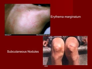 Erythema marginatum Subcutaneous Nodules 2009 