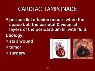 CARDIAC TAMPONADE pericardial effusion occurs when the space bet. the parietal & visceral layers of the pericardium fill with fluid.  Etiology: stab wound tumor surgery 2009 