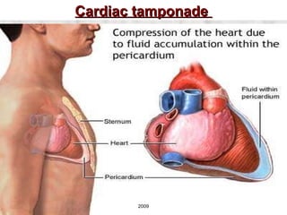 Cardiac tamponade   2009 