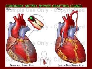CORONARY ARTERY BYPASS GRAFTING (CABG) 2009 