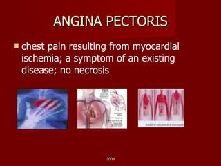 ANGINA PECTORIS chest pain resulting from myocardial ischemia; a symptom of an existing disease; no necrosis 2009 
