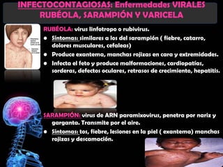 INFECTOCONTAGIOSAS: Enfermedades VIRALES
     RUBÉOLA, SARAMPIÓN Y VARICELA
     RUBÉOLA: virus linfotropo o rubivirus.
     • Síntomas: similares a los del sarampión ( fiebre, catarro,
       dolores musculares, cefaleas)
     • Produce exantema, manchas rojizas en cara y extremidades.
     • Infecta el feto y produce malformaciones, cardiopatías,
       sorderas, defectos oculares, retrasos de crecimiento, hepatitis.




     SARAMPIÓN: virus de ARN paramixovirus, penetra por nariz y
       garganta. Transmite por el aire.
     • Síntomas: tos, fiebre, lesiones en la piel ( exantema) manchas
       rojizas y descamación.
 