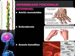 ENFERMEDADES FUNCIONALES
AUTOINMUNES.
• Artritis reumatoidea




• Esclerodermia




• Anemia hemolítica
 