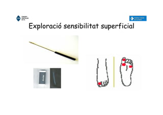 Exploració sensibilitat superficial
MONOFILAMENTO
DE SEMMES-
WEINSTEN
 