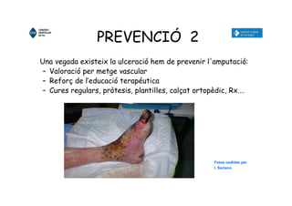 PREVENCIÓ 2
Una vegada existeix la ulceració hem de prevenir l'amputació:
– Valoració per metge vascular
– Reforç de l’educació terapéutica
– Cures regulars, pròtesis, plantilles, calçat ortopèdic, Rx….
Fotos cedides per
I. Soriano
 