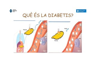 QUÈ ÉS LA DIABETIS?
 