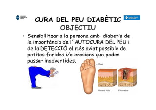 CURA DEL PEU DIABÈTIC
OBJECTIU
• Sensibilitzar a la persona amb diabetis de
la importància de l´AUTOCURA DEL PEU i
de la DETECCIÓ el més aviat possible de
petites ferides i/o erosions que poden
passar inadvertides.
 