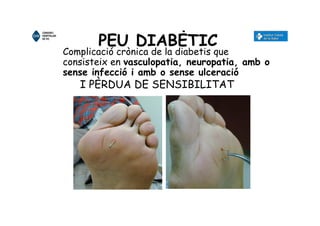 PEU DIABÈTIC
Complicació crònica de la diabetis que
consisteix en vasculopatia, neuropatia, amb o
sense infecció i amb o sense ulceració
I PÈRDUA DE SENSIBILITAT
 