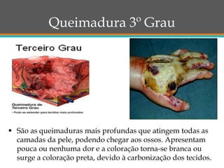 Queimadura 3º Grau
 São as queimaduras mais profundas que atingem todas as
camadas da pele, podendo chegar aos ossos. Apresentam
pouca ou nenhuma dor e a coloração torna-se branca ou
surge a coloração preta, devido à carbonização dos tecidos.
 