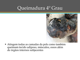 Queimadura 4º Grau
 Atingem todas as camadas da pele como também
queimam tecido adiposo, músculos, ossos além
de órgãos internos subjacentes
 