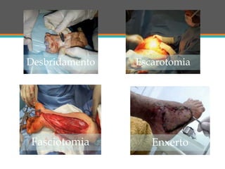 Desbridamento
Enxerto
Escarotomia
Fasciotomia
 