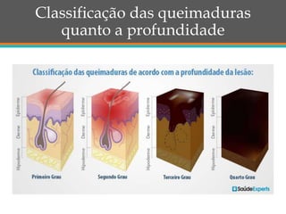 Classificação das queimaduras
quanto a profundidade
 