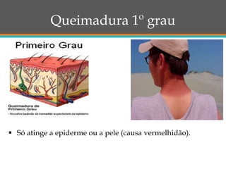 Queimadura 1º grau
 Só atinge a epiderme ou a pele (causa vermelhidão).
 