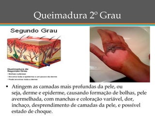 Queimadura 2º Grau
 Atingem as camadas mais profundas da pele, ou
seja, derme e epiderme, causando formação de bolhas, pele
avermelhada, com manchas e coloração variável, dor,
inchaço, desprendimento de camadas da pele, e possível
estado de choque.
 