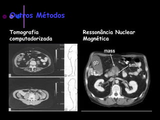 Outros Métodos
Tomografia
computadorizada
Ressonância Nuclear
Magnética
 