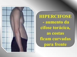 HIPERCIFOSE
  - aumento da
cifose torácica,
     as costas
ficam curvadas
   para frente
 