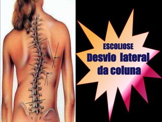 ESCOLIOSE
Desvio lateral
  da coluna
 