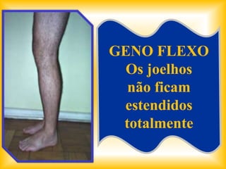 GENO FLEXO
  Os joelhos
  não ficam
 estendidos
 totalmente
 
