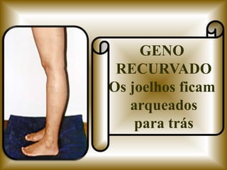 GENO
 RECURVADO
Os joelhos ficam
   arqueados
    para trás
 