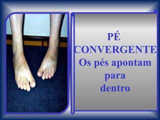 PÉ
CONVERGENTE
 Os pés apontam
      para
     dentro
 