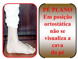 PLANO
Em posição
ortostática
  não se
visualiza a
   cava
   do pé
 