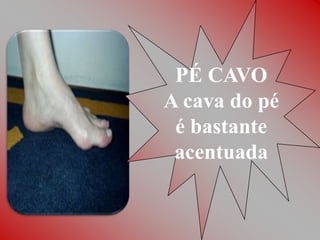 PÉ CAVO
A cava do pé
 é bastante
 acentuada
 