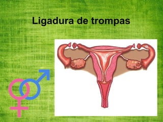 Ligadura de trompas
 