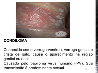 23
CONDILOMA
Conhecido como verruga-venérea, verruga genital e
crista de galo, causa o aparecimento na região
genital ou anal.
Causado pelo papiloma vírus humano(HPV). Sua
transmissão é predominante sexual.
 