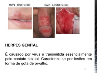 24
HERPES GENITAL
É causado por vírus e transmitida essencialmente
pelo contato sexual. Caracteriza-se por lesões em
forma de gota de orvalho.
 