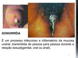 25
GONORRÉIA
É um processo infeccioso e inflamatório da mucosa
uretral ,transmitida de pessoa para pessoa durante a
relação sexual(genital, oral ou anal).
 