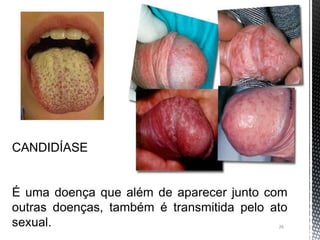 26
CANDIDÍASE
É uma doença que além de aparecer junto com
outras doenças, também é transmitida pelo ato
sexual.
 