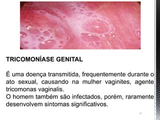 27
TRICOMONÍASE GENITAL
É uma doença transmitida, frequentemente durante o
ato sexual, causando na mulher vaginites, agente
tricomonas vaginalis.
O homem também são infectados, porém, raramente
desenvolvem sintomas significativos.
 