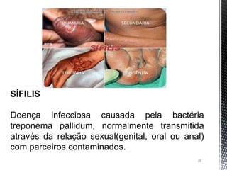 28
SÍFILIS
Doença infecciosa causada pela bactéria
treponema pallidum, normalmente transmitida
através da relação sexual(genital, oral ou anal)
com parceiros contaminados.
 