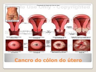 DIU – DISPOSITIVO INTRA-UTERINONão deve ser utilizado por adolescentes