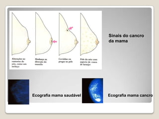 Caracteres sexuais secundários masculinos. Mudança na voz. . Desenvolvimento corporal por aumento da massa muscular. . Aumento do tamanho do pénis e dos testículos. . Poluçõesnocturnas. . Aparecimento do acne.. Aparecimento de pêlos nos órgãos genitais, axilas, etc. . Maior secreção da hormona testosterona