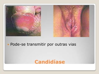 GRAVIDEZ NA ADOLESCÊNCIAAs relações sexuais, mesmo que seja a primeira vez ou só uma vez, podem ter como consequência a gravidez.Uma gravidez não desejada na adolescência pode ter consequências negativas no desenvolvimento físico, psicológico e social da jovem mãe.