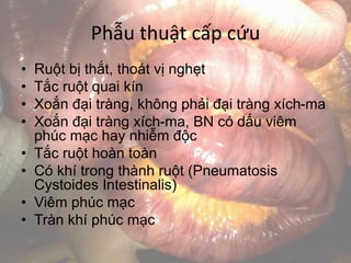 Phẫu thuật cấp cứu
• Ruột bị thắt, thoát vị nghẹt
• Tắc ruột quai kín
• Xoắn đại tràng, không phải đại tràng xích-ma
• Xoắn đại tràng xích-ma, BN có dấu viêm
phúc mạc hay nhiễm độc
• Tắc ruột hoàn toàn
• Có khí trong thành ruột (Pneumatosis
Cystoides Intestinalis)
• Viêm phúc mạc
• Tràn khí phúc mạc
 