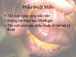 Phẫu thuật khẩn
• Tắc ruột ngày càng diễn tiến
• Không cải thiện sau 24-48 giờ
• Tắc ruột sớm sau phẫu thuật do sai sót kỹ
thuật
 